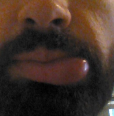 Puntura di un non precisato insetto malefico / IMG-20160720-WA0050_1469045580275.jpg IMG-20160720-WA0050_1469045580275.jpg